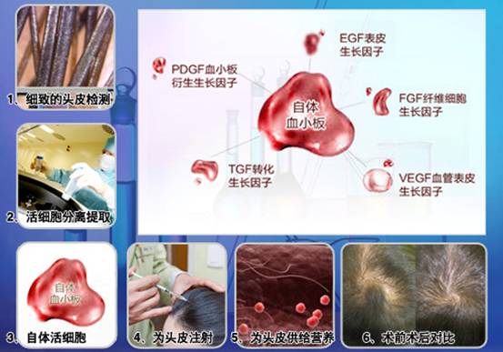 科發(fā)源的新傳奇:ST自體活細(xì)胞應(yīng)用