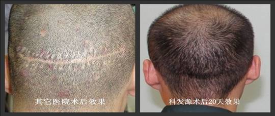 科發源第四屆交流會新亮點:FUT術后條狀變線痕