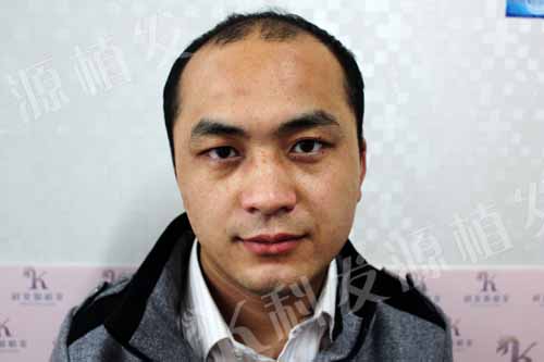 張青松:我之最 一次植發(fā)三種技術(shù)