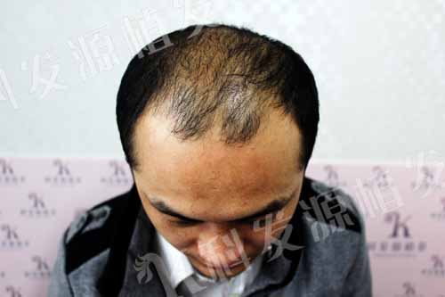 張青松:我之最 一次植發(fā)三種技術(shù)