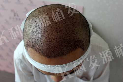 張青松:我之最 一次植發(fā)三種技術(shù)